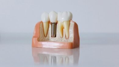 hungary dental implant services